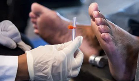 Amazonas participa de pesquisa que avalia a eficácia de medicamento para pé diabético