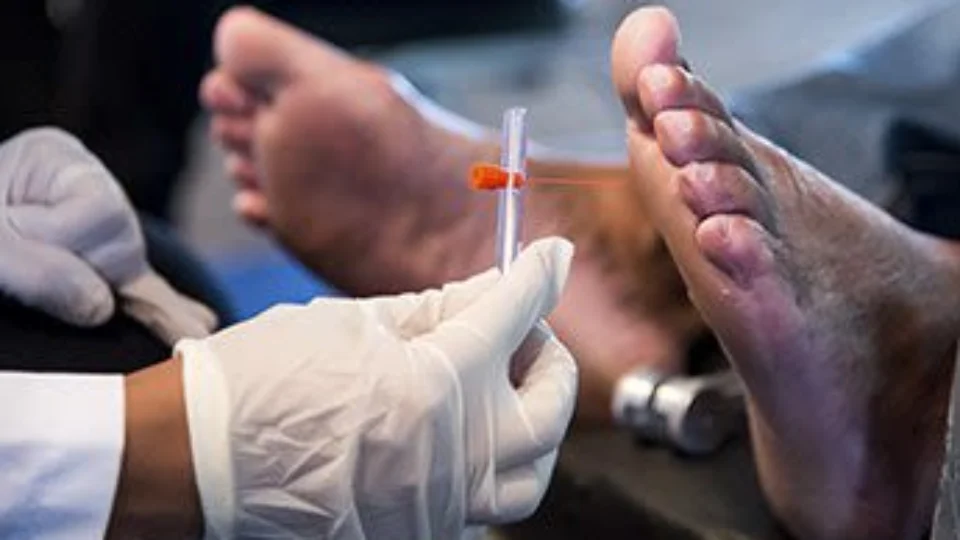 Amazonas participa de pesquisa que avalia a eficácia de medicamento para pé diabético