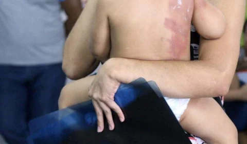 Padrasto espanca enteado após criança derrubar caldo de feijão quente no irmão mais novo