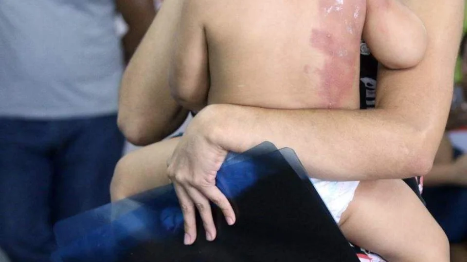 Padrasto espanca enteado após criança derrubar caldo de feijão quente no irmão mais novo