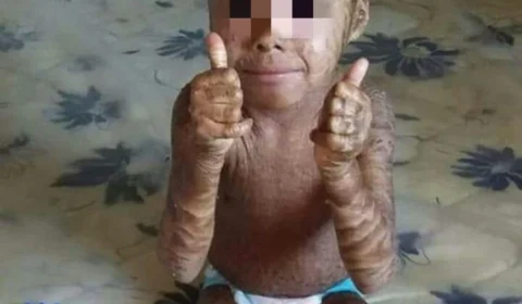 Policiais Militares do CPA Leste realizam campanha para ajudar criança com doença rara de pele