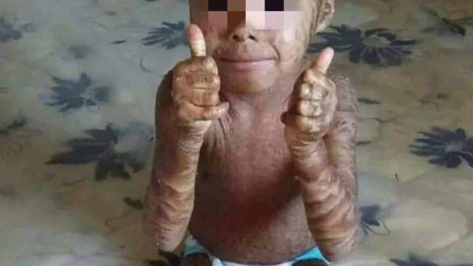 Policiais Militares do CPA Leste realizam campanha para ajudar criança com doença rara de pele