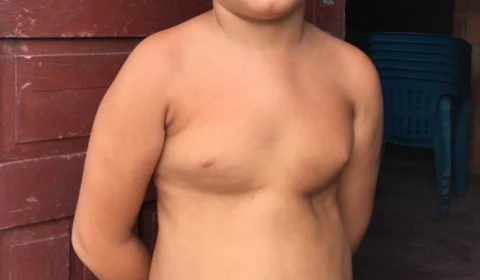 Feijoada beneficente arrecada dinheiro para cirurgia de criança com malformação no tórax