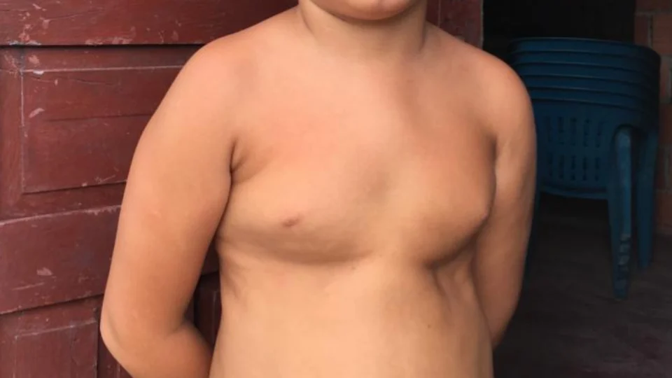 Feijoada beneficente arrecada dinheiro para cirurgia de criança com malformação no tórax