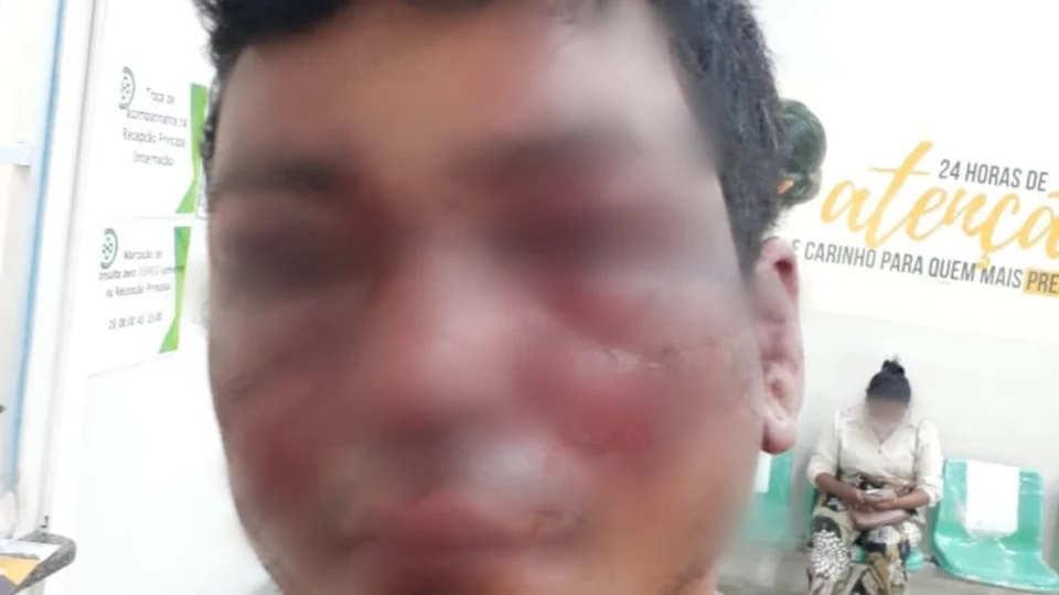 Pedreiro tem rosto desfigurado e quase é executado por traficante, após suposto furto de R$ 5 mil
