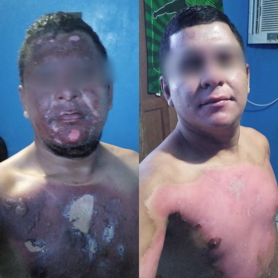 Veja vídeo;Panela explode e homem sofre graves queimaduras.