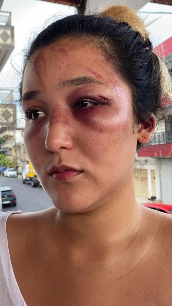 Após espancar a ex namorada, agressor se livra da prisão por expirar o período de flagrante, mas segue foragido.