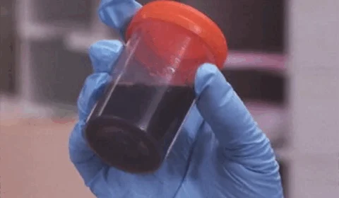 Amazonas cria grupo para investigar e combater surto de doença da urina preta – rabdomiólise