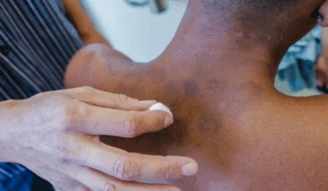 Janeiro Roxo alerta para a conscientização sobre a hanseníase