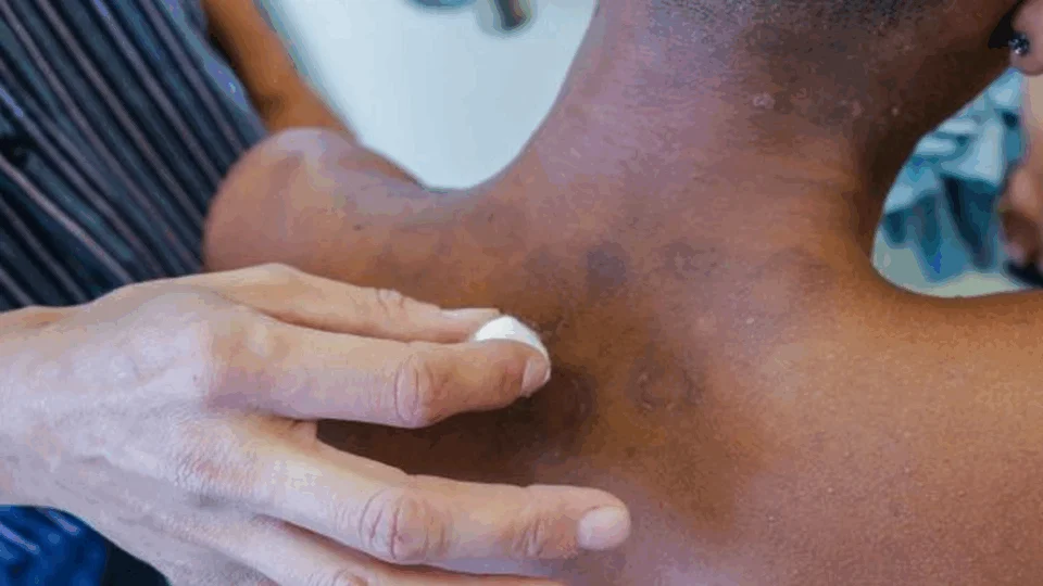 Janeiro Roxo alerta para a conscientização sobre a hanseníase