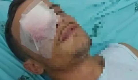 Após ser agredida com um soco, jovem fura o olho do namorado