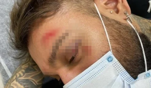 Vídeo e fotos! Cantor Lucas Lucco aparece com hematomas após queda