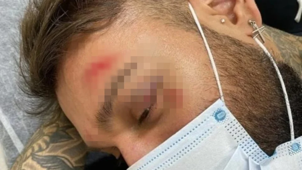 Vídeo e fotos! Cantor Lucas Lucco aparece com hematomas após queda