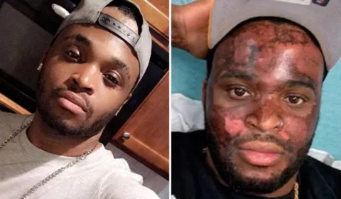 VEJA VÍDEO: TikToker fica com rosto queimado por tratamento de peeling químico