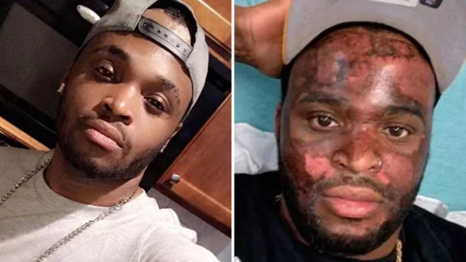 VEJA VÍDEO: TikToker fica com rosto queimado por tratamento de peeling químico