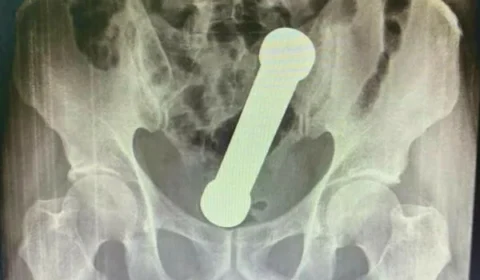 Para satisfação sexual, paciente fica com peso de academia preso no corpo em Manaus