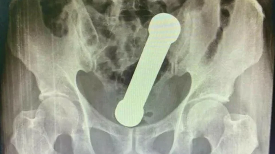 Para satisfação sexual, paciente fica com peso de academia preso no corpo em Manaus