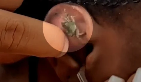 VEJA VÍDEO: Mulher tem caranguejo retirado de ouvido após mergulho no mar