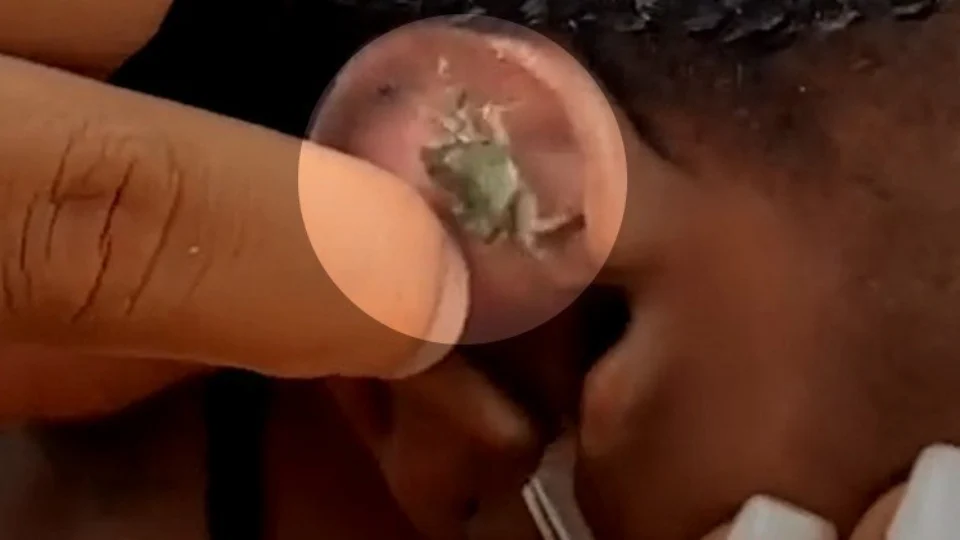 VEJA VÍDEO: Mulher tem caranguejo retirado de ouvido após mergulho no mar