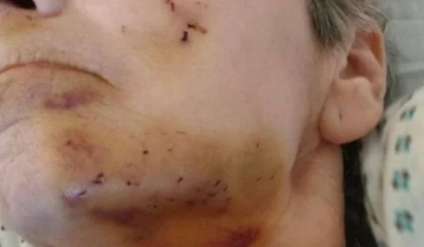 Ratazana ataca idosa e deixa rosto “desfigurado”; veja foto