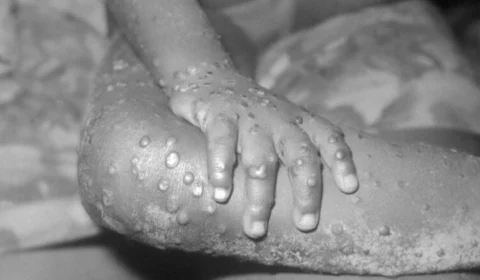 URGENTE: Brasil investiga 1º caso suspeito de varíola dos macacos no país