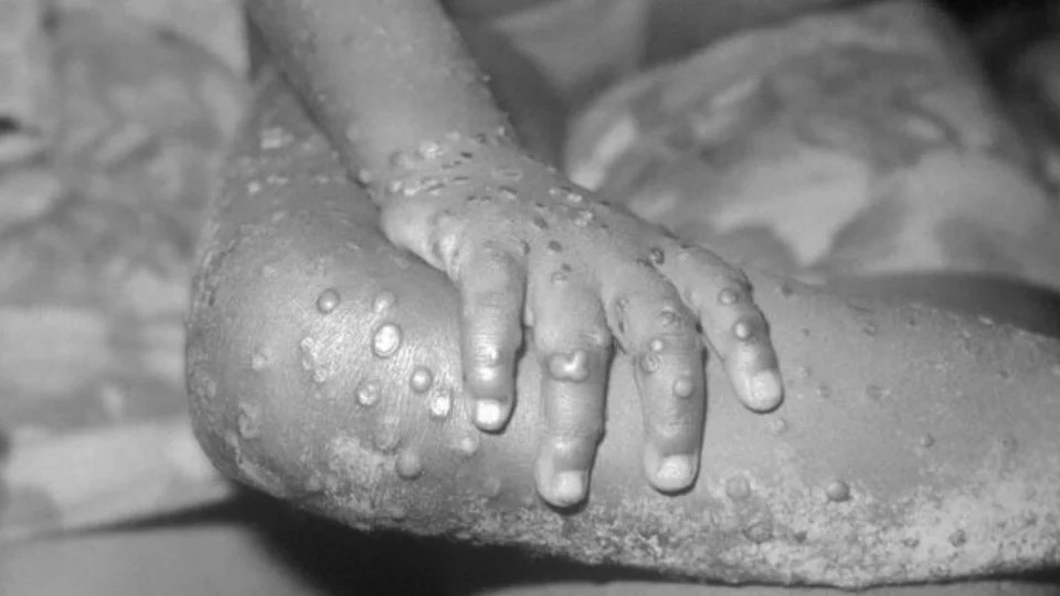 URGENTE: Brasil investiga 1º caso suspeito de varíola dos macacos no país