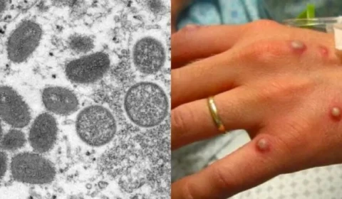 Primeiro caso de varíola dos macacos no Brasil é confirmado