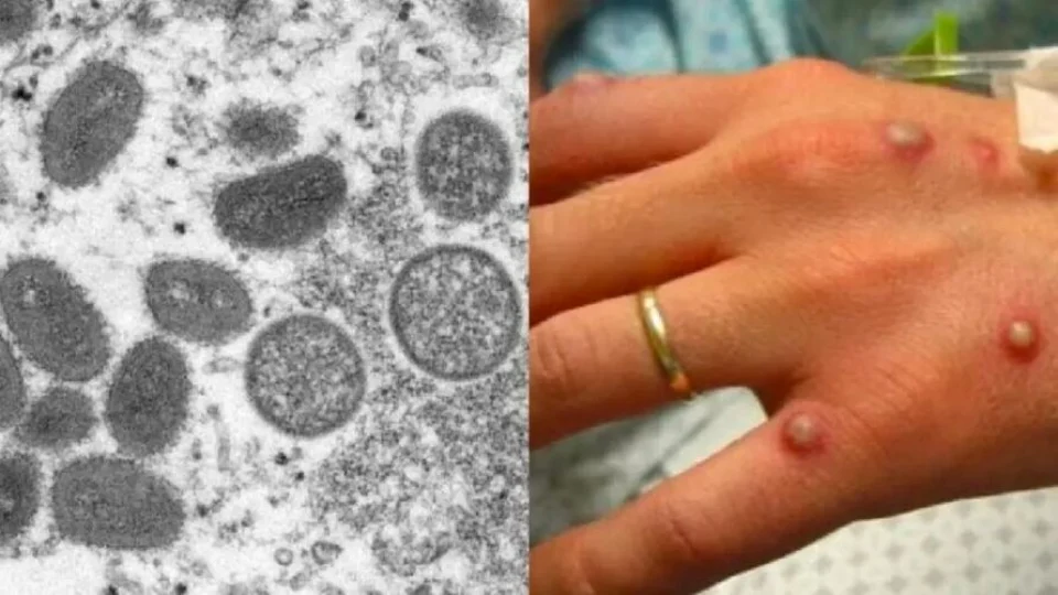 Primeiro caso de varíola dos macacos no Brasil é confirmado