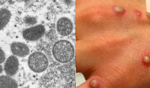 Varíola dos macacos: Brasil soma 21 diagnósticos confirmados da doença