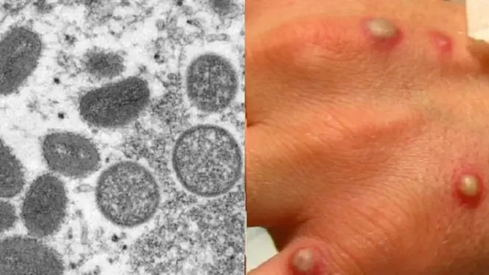Varíola dos macacos: Brasil soma 21 diagnósticos confirmados da doença