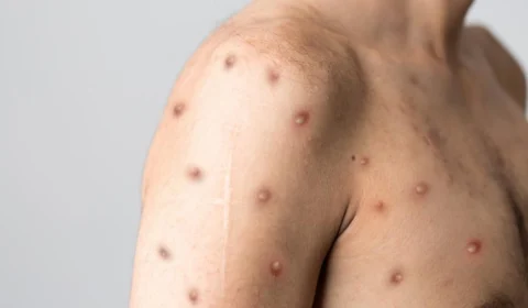 Brasil registra primeira morte por varíola dos macacos