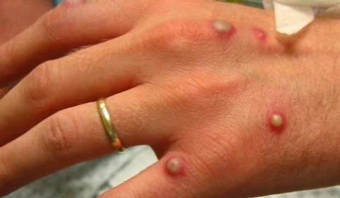 Ministério da Saúde confirma 76 casos de varíola dos macacos no país