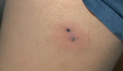 Criança de 9 anos é mordida por rato na escola