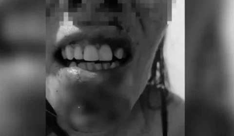 Homem agride ex-companheira com mordidas e marteladas