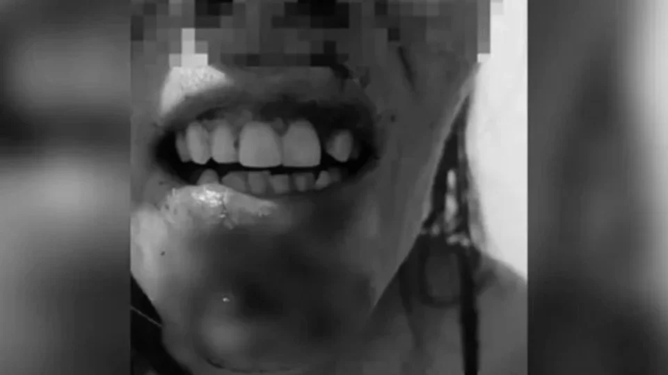 Homem agride ex-companheira com mordidas e marteladas