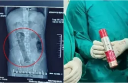 Homem passa por cirurgia de 2 horas para retirar desodorante do ânus