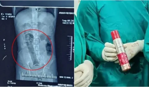 Homem passa por cirurgia de 2 horas para retirar desodorante do ânus