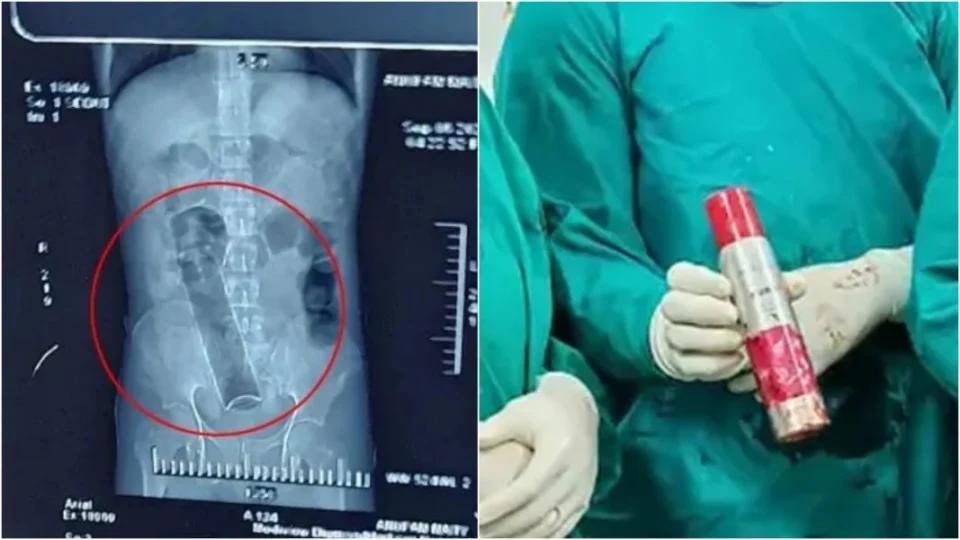 Homem passa por cirurgia de 2 horas para retirar desodorante do ânus