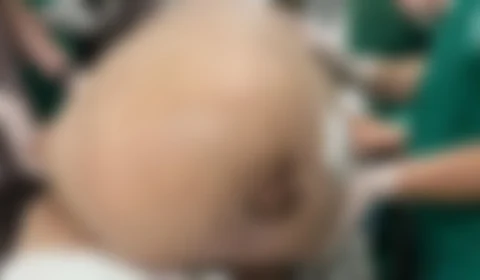 Morre mulher que retirou tumor de 46 kg um dia antes de alta médica