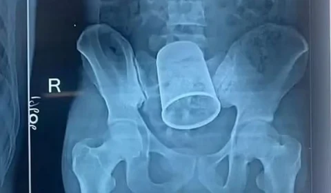 Jovem passa por cirurgia para retirar copo de metal do corpo