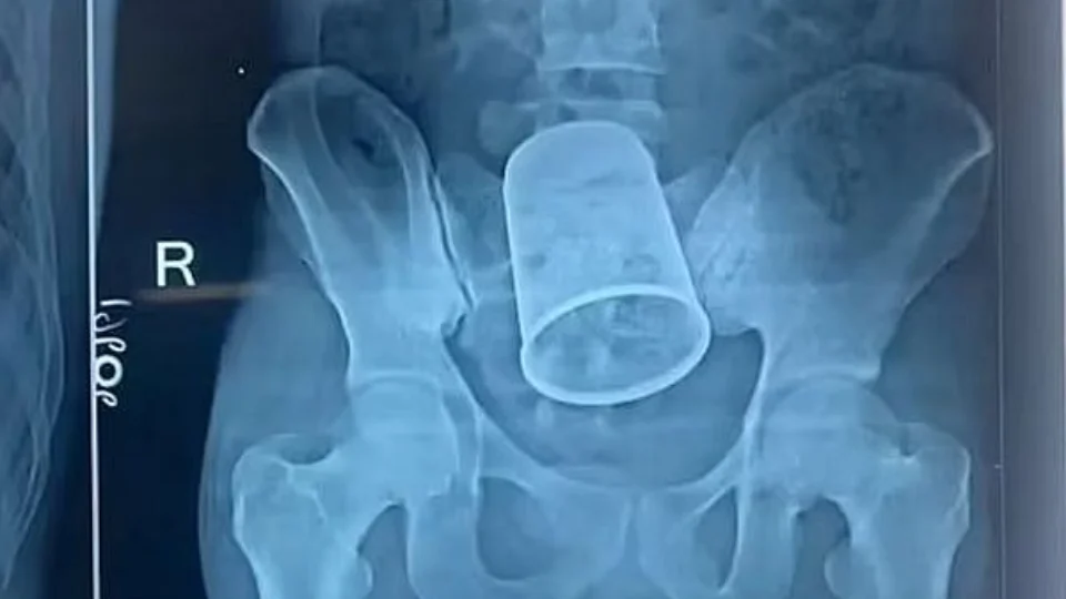 Jovem passa por cirurgia para retirar copo de metal do corpo