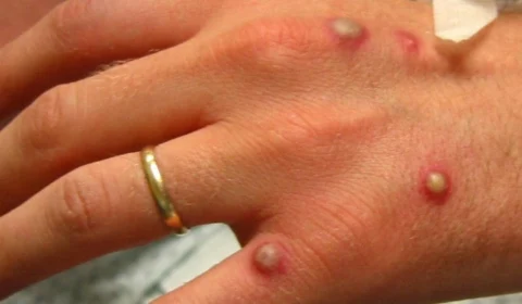OMS muda nome e varíola do macaco passa a ser chamada de ‘mpox’