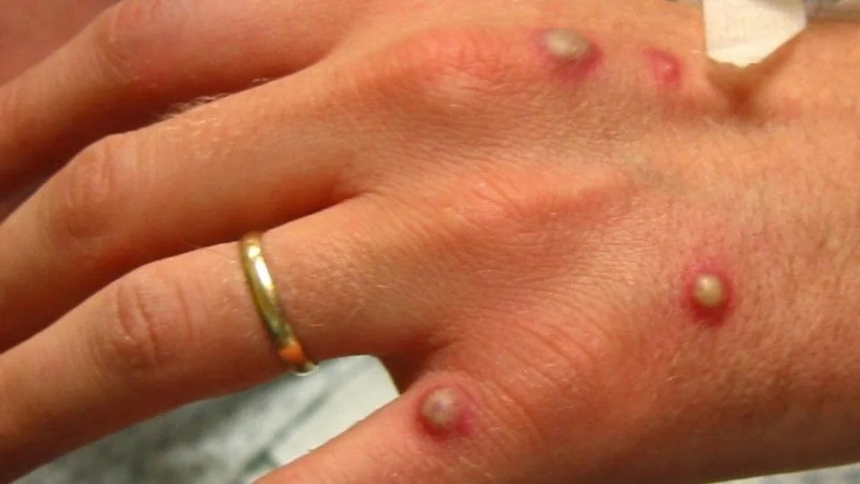 OMS muda nome e varíola do macaco passa a ser chamada de ‘mpox’