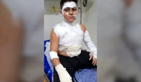 Menino de 10 anos fica ferido após mangueira de fogão explodir