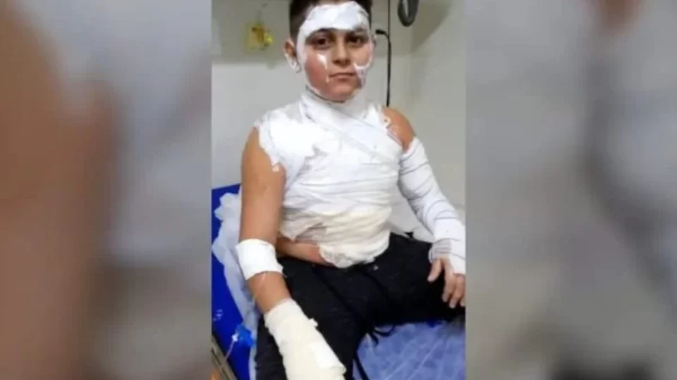 Menino de 10 anos fica ferido após mangueira de fogão explodir