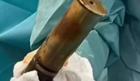 Idoso faz hospital ser evacuado ao chegar com bomba presa no ânus