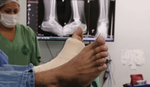 Saúde do Amazonas reforça medidas de prevenção sobre traumas ortopédicos