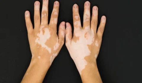 Vitiligo: saúde faz alerta para alto número de casos no Estado