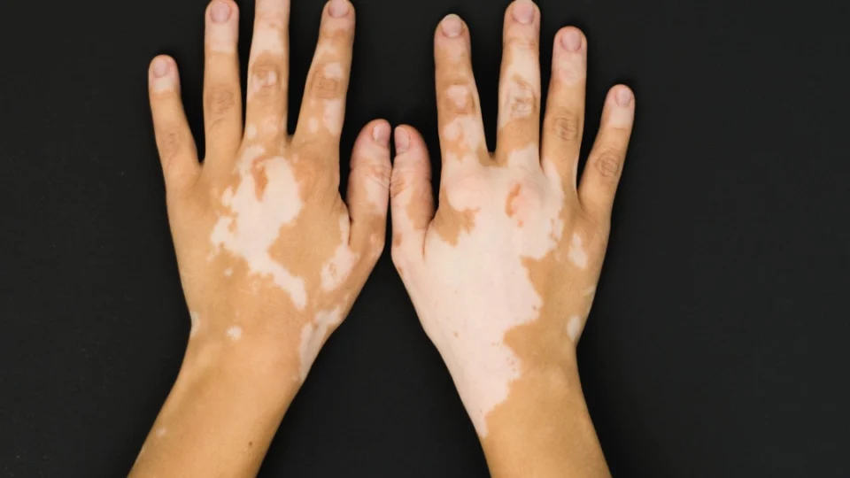 Vitiligo: saúde faz alerta para alto número de casos no Estado