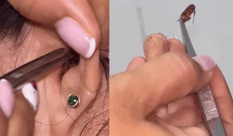 VEJA VÍDEO: após sentir ‘estouros’, mulher tem barata retirada do ouvido